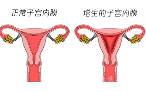 白带常规午夜精品无码免费视频厂家解读子宫内膜增生是什么原因引起的